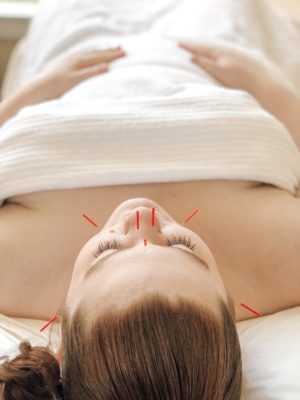 Acupuncture Answers Here!